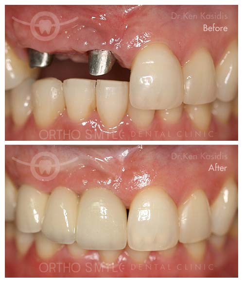 3_dental_implant_case1.jpg