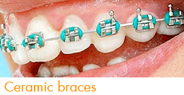 ceramic braces