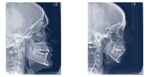 Orthodontic treatment