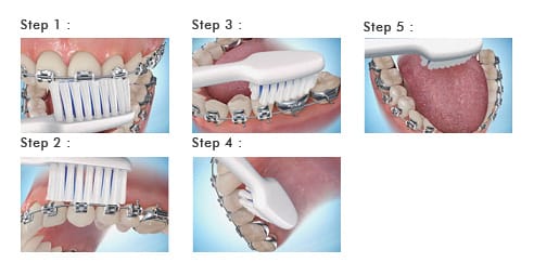 Braces Care Guidelines