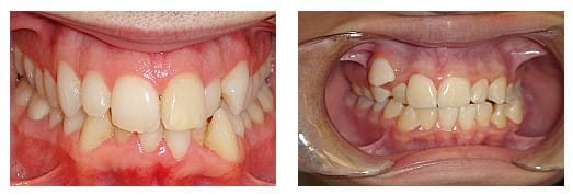 Often crowded teeth