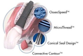 Astra Tech Implant System