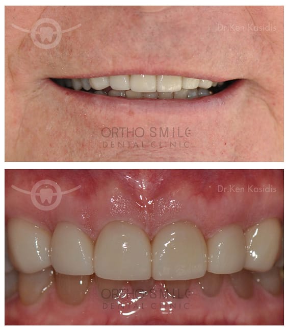 Empress Esthetic veneers done by Dr. Ken Kasidis