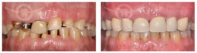 Full mouth rehabilitation with ceramic crowns 1