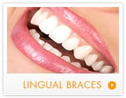 lingual braces