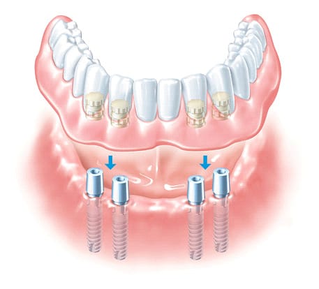 dental implants