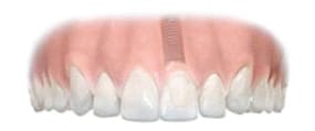 The new tooth is now complete and it is virtually impossible to see the difference between the existing teeth and the new tooth
