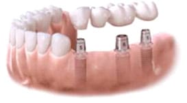 Abutments are attached to the dental implants.