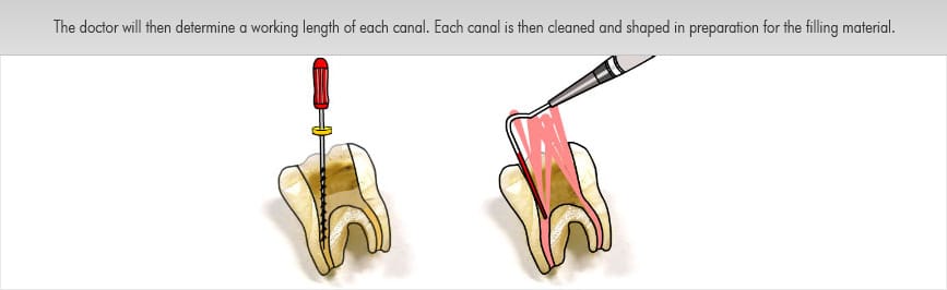 root canal treatment