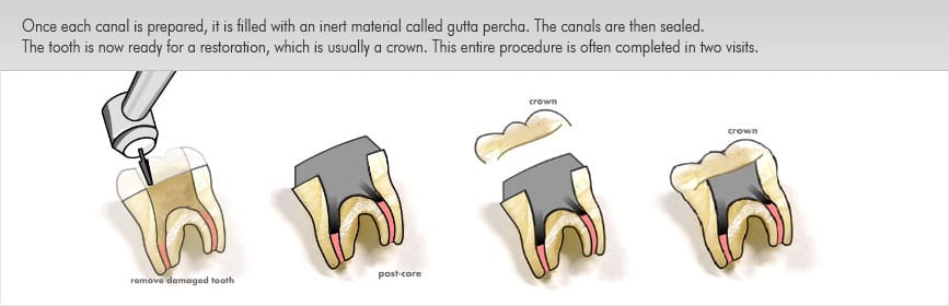 root canal treatment