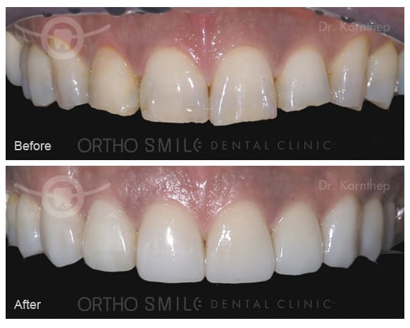 Empress Esthetic veneers done by Dr. Kornthep