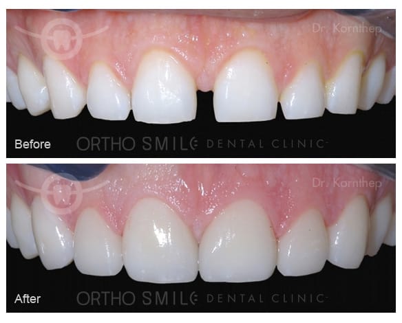 Empress Esthetic veneers done by Dr. Kornthep