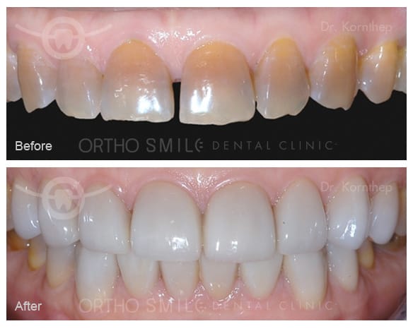 Empress Esthetic veneers done by Dr. Kornthep