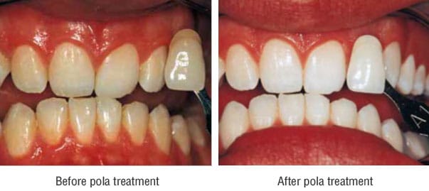 How To Whiten Teeth Overnight Shefalitayal